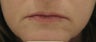 Fraxel re:pair (repair) for lip lines and lip enhancement