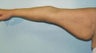 44 year old woman who underwent an arm lift 