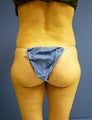 Liposuction of Buttock and Thighs