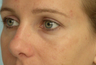 Restylane