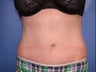 Tummy Tuck
