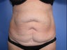 Tummy Tuck