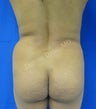 Brazilian Butt Lift