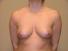 Breast Implants