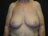 Massive-weight loss surgery - breasts