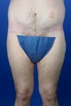 36 Year Old Weight Loss Patient Treated With Medial Thigh Lift