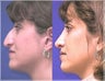 Rhinoplasty