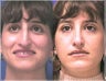 Rhinoplasty