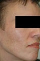 Melasma Los Angeles - No Laser Treatment