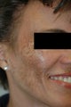 Melasma Los Angeles - No Laser Treatment