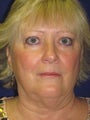 Face and Necklift
