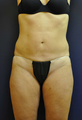 41 Year old Female Liposuction abdomen, inner thighs and knees