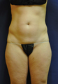 41 Year old Female Liposuction abdomen, inner thighs and knees