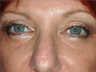 Eyelid Surgery