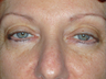 Eyelid Surgery