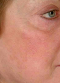 Vein Treatment