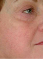 Vein Treatment