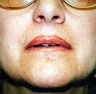 Lip Augmentation