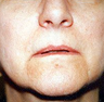Lip Augmentation