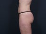Liposuction Abdomen, Flanks, Inner & Outer Thighs