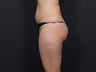 Liposuction Abdomen, Flanks, Inner & Outer Thighs