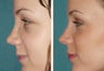 Rhinoplasty