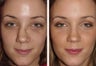 Rhinoplasty