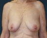Breast Lift (Mastopexy)