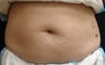 Coolsculpting Abdomen