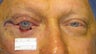 Eyelid skin cancer surgery