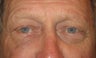 Eyelid skin cancer surgery