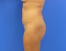 Brazilian Butt Lift 