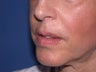 Injectable Fillers