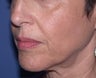Injectable Fillers