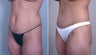 Tummy Tuck