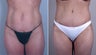 Tummy Tuck