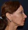 Facelift