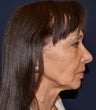 Facelift