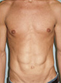 Liposuction