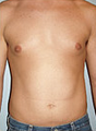 Liposuction