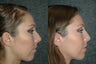 Rhinoplasty