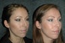 Rhinoplasty