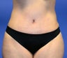 Tummy Tuck