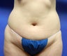 Tummy Tuck