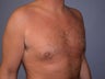 Gynecomastia