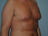 Gynecomastia