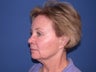 Neck lift