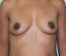 34-Year-Old Female Breast Augmentation