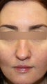 36 year old Female - Dysport and Restylane