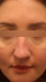 36 year old Female - Dysport and Restylane